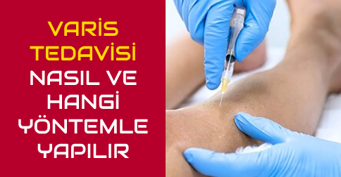 varis tedavisi nasıl olur
