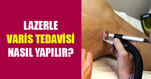 lazerle varis tedavisi nasıl yapılır